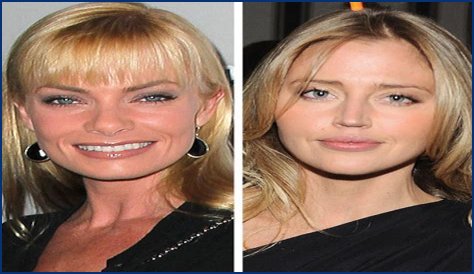 Estella Warren Plastic Surgery Before and After